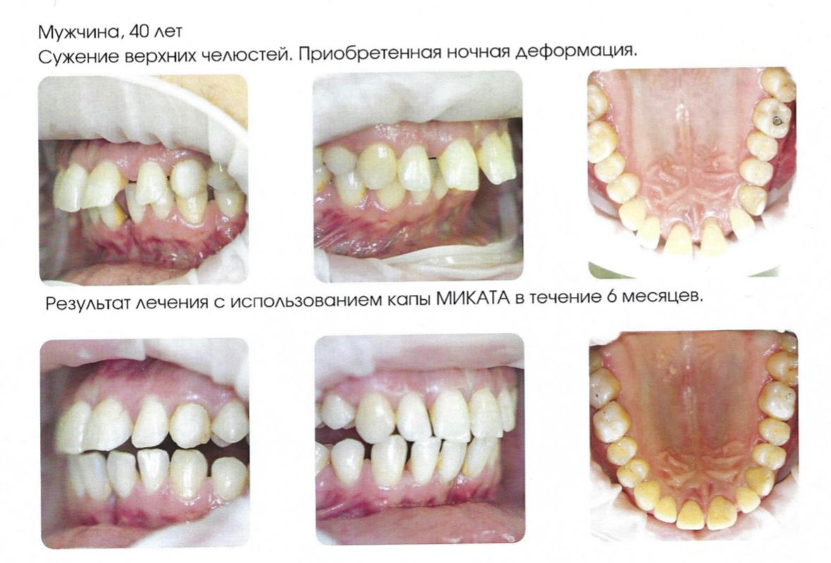 Фото результата лечения - до и после Результат исправления прикуса 1