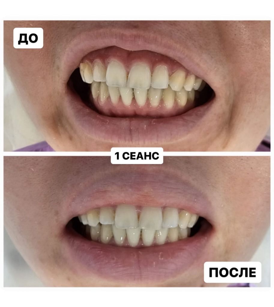 Фото результата лечения корректором МИКАТА Результат коррекции МИКАТА №3