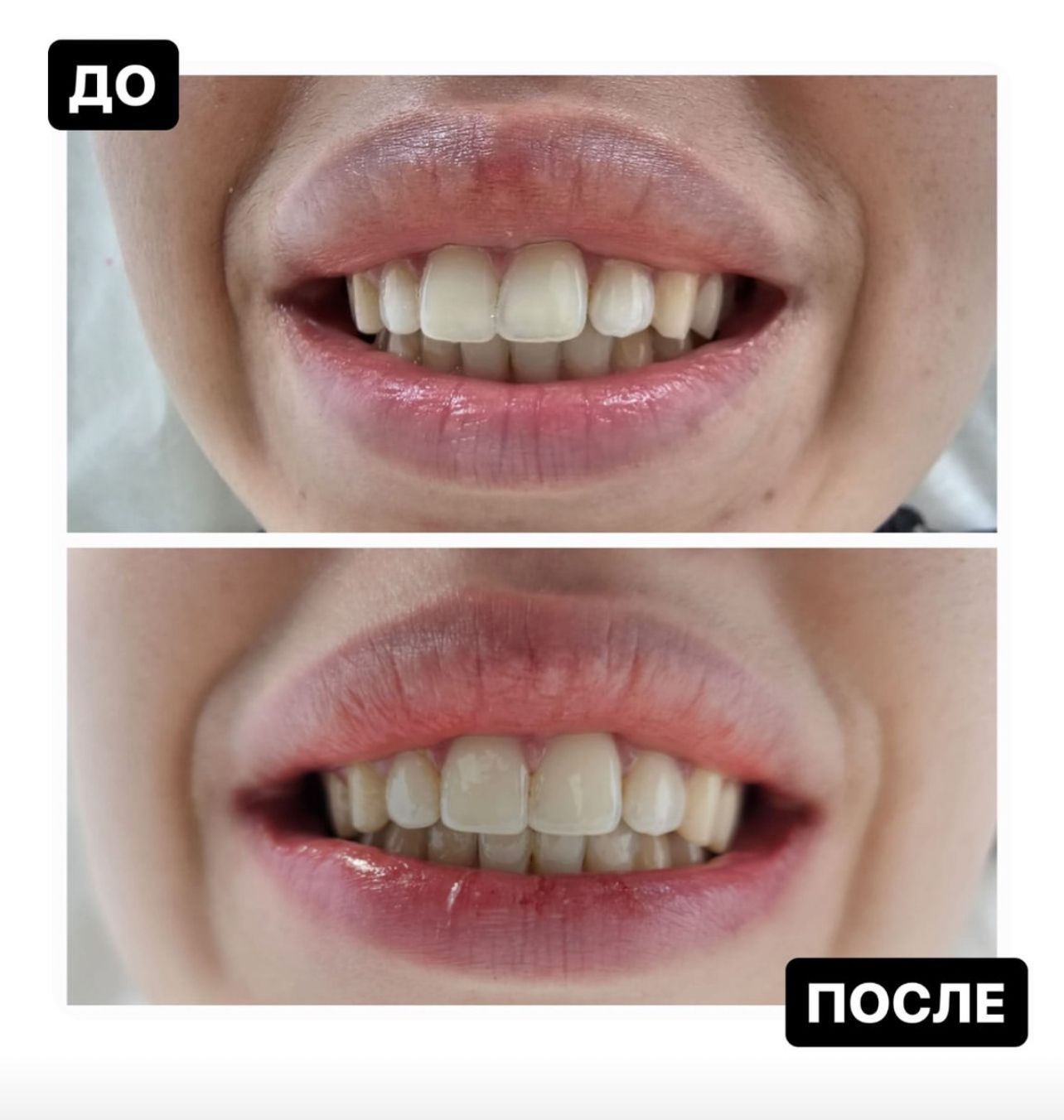 Фото результата лечения корректором МИКАТА Результат коррекции МИКАТА №7