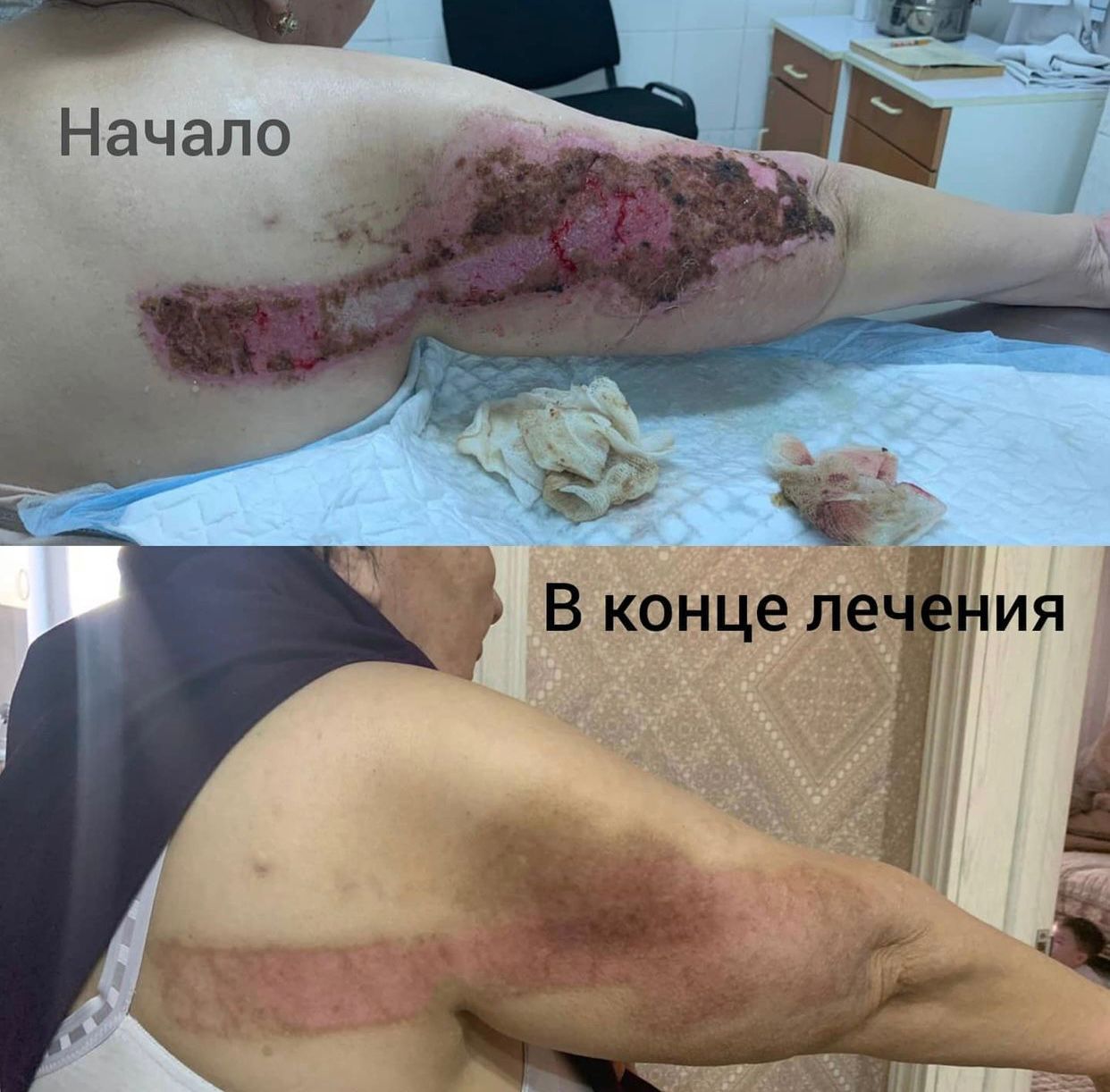 Прогресс заживления раны в динамике Результат лечения раны №01