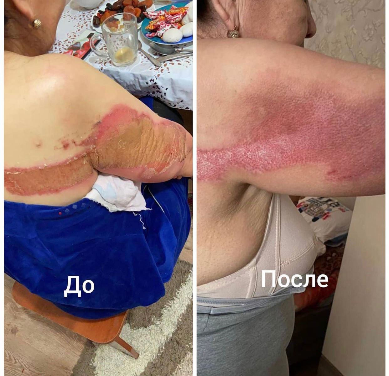 Прогресс заживления раны в динамике Результат лечения раны №02